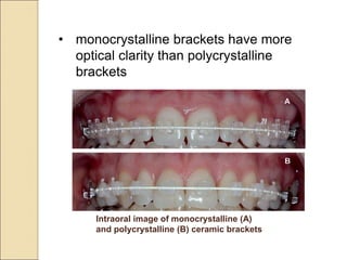 • monocrystalline brackets have more
optical clarity than polycrystalline
brackets
Intraoral image of monocrystalline (A)
and polycrystalline (B) ceramic brackets
 