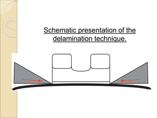 Schematic presentation of the
delamination technique.
 