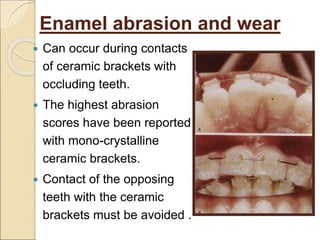 Enamel abrasion and wear
 Can occur during contacts
of ceramic brackets with
occluding teeth.
 The highest abrasion
scores have been reported
with mono-crystalline
ceramic brackets.
 Contact of the opposing
teeth with the ceramic
brackets must be avoided .
 