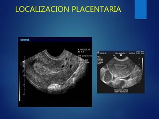 LOCALIZACION PLACENTARIA
 