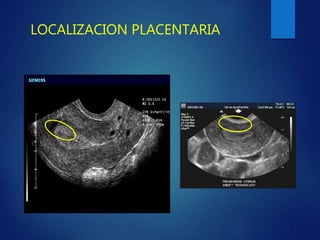 LOCALIZACION PLACENTARIA
 