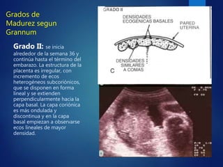 Grados de
Madurez segun
Grannum
Grado II: se inicia
alrededor de la semana 36 y
continúa hasta el término del
embarazo. La estructura de la
placenta es irregular, con
incremento de ecos
heterogéneos subcoriónicos,
que se disponen en forma
lineal y se extienden
perpendicularmente hacia la
capa basal. La capa coriónica
es más ondulada y
discontinua y en la capa
basal empiezan a observarse
ecos lineales de mayor
densidad.
 
