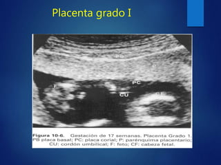 Placenta grado I
 
