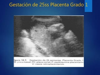 Gestación de 25ss Placenta Grado 1
 