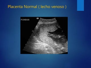 Placenta Normal ( lecho venoso )
 