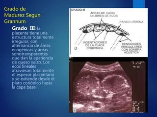 Grado de
Madurez Segun
Grannum
Grado III: la
placenta tiene una
estructura totalmente
irregular, con
alternancia de áreas
...