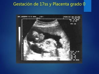 Gestación de 17ss y Placenta grado 0
 