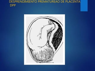 Desprendimiento Prematuro de Placenta
 