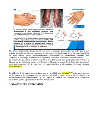 Los tofos a nivel articular imagen permite ver cómo se acumulan estos cristales de ácido úrico a nivel
articular formando precisamente estas masa o estás protuberancias de ácido úrico. La mayoría de forma
de gotas pueden tratarse farmacológicamente administrando el antimetabolito alopurinol, está
compuesto es un análogo estructural de la hipoxantina que inhibe fuertemente la xantina-oxidasa.
Es un indicador que ejerce un efecto competitivo trato de la enzima para que pueda actuar el fármaco y
bloquear de los bloques de purina y por lo tanto se bloquean la producción de ácido úrico también por
parte del tratamiento de la gota está el control dietético y el suministro de otros fármacos
tiocolchicósido??
La inhibición de la enzima xantina-oxidasa, que se ve inhibida por alopurinol?? Y ocasiona un aumento
de la xantina y la hipoxantina que se convierte en GMP y AMP, estos a su vez inhiben a la
fosforribosilpirofosfato-aminotransferasa, y ello explica la eficiencia de alopurinol en la disminución
de la síntesis purina y por ende la formación de ácido úrico.
SÍNDROME DE LESCH-NYHAN
 