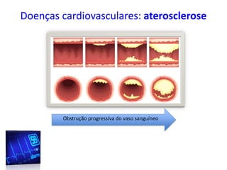 Doenças cardiovasculares: aterosclerose
Obstrução progressiva do vaso sanguíneo
 
