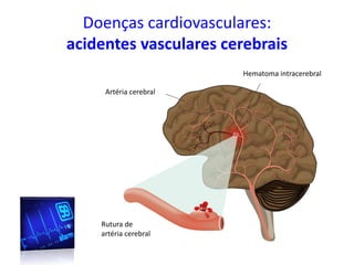 Doenças cardiovasculares:
acidentes vasculares cerebrais
Hematoma intracerebral
Artéria cerebral
Rutura de
artéria cerebral
 