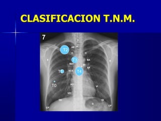 T0
T1
T2
T3
T4
CLASIFICACION T.N.M.
 
