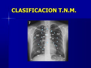 CLASIFICACION T.N.M.
N0
N2
N3 N4
 
