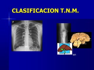 M0
M1
CLASIFICACION T.N.M.
 