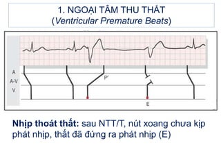 1. NGOẠI TÂM THU THẤT
(Ventricular Premature Beats)
Nhịp thoát thất: sau NTT/T, nút xoang chưa kịp
phát nhịp, thất đã đứng ra phát nhịp (E)
 