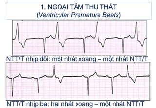 NTT/T nhịp đôi: một nhát xoang – một nhát NTT/T
1. NGOẠI TÂM THU THẤT
(Ventricular Premature Beats)
NTT/T nhịp ba: hai nhát xoang – một nhát NTT/T
 