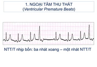 NTT/T nhịp bốn: ba nhát xoang – một nhát NTT/T
1. NGOẠI TÂM THU THẤT
(Ventricular Premature Beats)
 