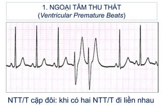 1. NGOẠI TÂM THU THẤT
(Ventricular Premature Beats)
NTT/T cặp đôi: khi có hai NTT/T đi liền nhau
 