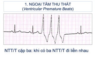 1. NGOẠI TÂM THU THẤT
(Ventricular Premature Beats)
NTT/T cặp ba: khi có ba NTT/T đi liền nhau
 