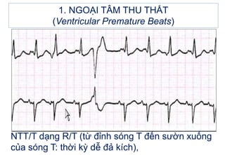 1. NGOẠI TÂM THU THẤT
(Ventricular Premature Beats)
NTT/T dạng R/T (từ đỉnh sóng T đến sườn xuống
của sóng T: thời kỳ dễ đả kích),
 