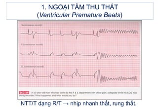 NTT/T dạng R/T → nhịp nhanh thất, rung thất.
1. NGOẠI TÂM THU THẤT
(Ventricular Premature Beats)
 