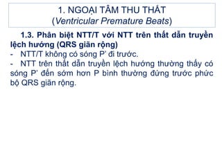 1. NGOẠI TÂM THU THẤT
(Ventricular Premature Beats)
1.3. Phân biệt NTT/T với NTT trên thất dẫn truyền
lệch hướng (QRS giãn rộng)
- NTT/T không có sóng P’ đi trước.
- NTT trên thất dẫn truyền lệch hướng thường thấy có
sóng P’ đến sớm hơn P bình thường đứng trước phức
bộ QRS giãn rộng.
 