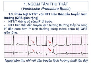 Ngoại tâm thu nhĩ với dẫn truyền lệch hướng (mũi tên đỏ)
1. NGOẠI TÂM THU THẤT
(Ventricular Premature Beats)
1.3. Phân biệt NTT/T với NTT trên thất dẫn truyền lệch
hướng (QRS giãn rộng)
- NTT/T không có sóng P’ đi trước.
- NTT trên thất dẫn truyền lệch hướng thường thấy có sóng
P’ đến sớm hơn P bình thường đứng trước phức bộ QRS
giãn rộng.
 