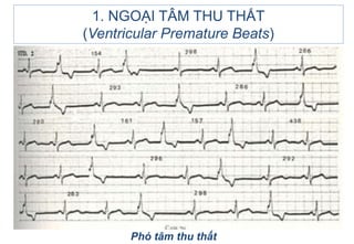 1. NGOẠI TÂM THU THẤT
(Ventricular Premature Beats)
Phó tâm thu thất
 