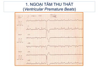 1. NGOẠI TÂM THU THẤT
(Ventricular Premature Beats)
 