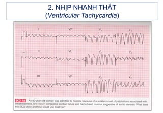 2. NHỊP NHANH THẤT
(Ventricular Tachycardia)
 