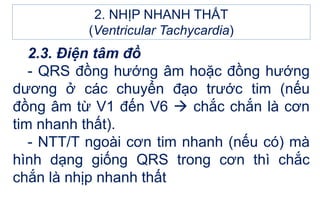 2. NHỊP NHANH THẤT
(Ventricular Tachycardia)
2.3. Điện tâm đồ
- QRS đồng hướng âm hoặc đồng hướng
dương ở các chuyển đạo trước tim (nếu
đồng âm từ V1 đến V6  chắc chắn là cơn
tim nhanh thất).
- NTT/T ngoài cơn tim nhanh (nếu có) mà
hình dạng giống QRS trong cơn thì chắc
chắn là nhịp nhanh thất
 