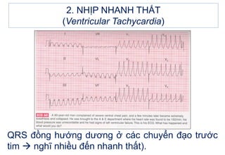 2. NHỊP NHANH THẤT
(Ventricular Tachycardia)
QRS đồng hướng dương ở các chuyển đạo trước
tim  nghĩ nhiều đến nhanh thất).
 