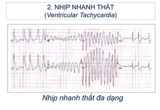 2. NHỊP NHANH THẤT
(Ventricular Tachycardia)
Nhịp nhanh thất đa dạng
 