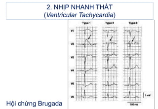 2. NHỊP NHANH THẤT
(Ventricular Tachycardia)
Hội chứng Brugada
 
