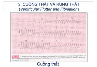 3. CUỒNG THẤT VÀ RUNG THẤT
(Ventricular Flutter and Fibrilation)
Cuồng thất
 