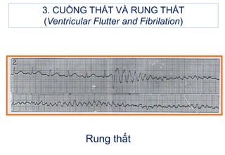 3. CUỒNG THẤT VÀ RUNG THẤT
(Ventricular Flutter and Fibrilation)
Rung thất
 