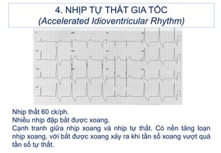 Nhịp thất 60 ck/ph.
Nhiều nhịp đập bắt được xoang.
Cạnh tranh giữa nhịp xoang và nhịp tự thất. Có nền tảng loạn
nhịp xoang, với bắt được xoang xảy ra khi tần số xoang vượt quá
tần số tự thất.
4. NHỊP TỰ THẤT GIA TỐC
(Accelerated Idioventricular Rhythm)
 