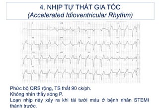 4. NHỊP TỰ THẤT GIA TỐC
(Accelerated Idioventricular Rhythm)
Phức bộ QRS rộng, TS thất 90 ck/ph.
Không nhìn thấy sóng P.
Loạn nhịp này xảy ra khi tái tưới máu ở bệnh nhân STEMI
thành trước.
 