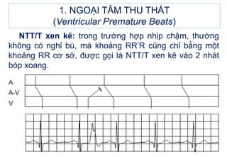 1. NGOẠI TÂM THU THẤT
(Ventricular Premature Beats)
NTT/T xen kẽ: trong trường hợp nhịp chậm, thường
không có nghỉ bù, mà khoảng RR’R cũng chỉ bằng một
khoảng RR cơ sở, được gọi là NTT/T xen kẽ vào 2 nhát
bóp xoang.
 