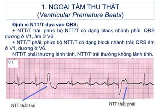 1. NGOẠI TÂM THU THẤT
(Ventricular Premature Beats)
Định vị NTT/T dựa vào QRS:
+ NTT/T trái: phức bộ NTT/T có dạng block nhánh phải: QRS
dương ở V1, âm ở V6.
+ NTT/T phải: phức bộ NTT/T có dạng block nhánh trái: QRS âm
ở V1, dương ở V6.
NTT/T phải thường lành tính, NTT/T trái thường không lành tính.
 