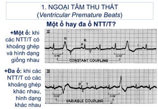 1. NGOẠI TÂM THU THẤT
(Ventricular Premature Beats)
Một ổ hay đa ổ NTT/T?
+Một ổ: khi
các NTT/T có
khoảng ghép
và hình dạng
giống nhau
+Đa ổ: khi các
NTT/T có các
khoảng ghép
khác nhau,
hình dạng
khác nhau
 