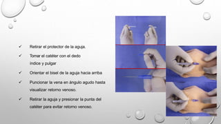  Retirar el protector de la aguja.
 Tomar el catéter con el dedo
índice y pulgar
 Orientar el bisel de la aguja hacia arriba
 Puncionar la vena en ángulo agudo hasta
visualizar retorno venoso.
 Retirar la aguja y presionar la punta del
catéter para evitar retorno venoso.
 