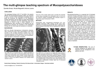 CONCLUSION
The radiological findings at XR, CT and MRI in the patients
affected with Mucopolysaccharidoses (MPS) are important
to give a common clinical radiological knowledge base to
guide the screening, the diagnosis for the subsequent
surgical intervention and the follow-up whose abnormalities
are chronic, progressive and often debilitating. Since early
diagnosis is crucial to plan a timely treatment in a
multidisciplinary team according to the expertise and the
experience of clinicians; the correlation of the radiological
findings with the clinical signs and symptoms is necessary.
BACKGROUND
MPS are clinically heterogeneous multisystemic diseases,
often involving the spine. Bony abnormalities of the spine
included in the so-called dysostosis multiplex (fig.1) and
Glycosaminoglycans (GAGs) deposits in the dura mater and
supporting ligaments can result in spinal cord compression,
which can lead to compressive myelopathy.
Fig.1) MPS IVA in a 21-year-old man. a,b – Sagittal reformatted CT
images of the lumbar spine (a) and thoracolumbar junction (b) show
some typical thoracolumbar spine changes including platyspondyly,
anterior beaking within the midportion of the vertebral bodies (small
arrows in a and b) and posterior scalloping of the vertebral bodies
(arrows in a and b).
PURPOSE
The aim of this review article was to provide the required
clinical deep knowledge that radiologists need to know and
the relevant imaging knowledge that clinicians require in
diagnosing spinal involvement in MPS.
METHODS
Radiography (XR), computerized tomography (CT), and
magnetic resonance (MR) imaging of the spine were
performed for screening patients with MPS, optimizing the
time for surgical intervention and for assessing the impact of
treatment.
.
RESULTS
Mucopolysaccharidosis is a congenital set of inheritable
lysosomal storage pathologies caused by mutations in
the genes coding for enzymes involved in the catabolism
of different GAGs. Spinal involvement of MPS (Fig.2) is
the major cause of morbidity and mortality and requires
a common radiological basis for a multidisciplinary
approach because of the multiorgan nature of the
disease at the very early stages to prevent or arrest
neurological deterioration and the loss of function. Spinal
abnormalities which are the most prominent features
and the common denominator of many MPS types are
chronic, progressive, often debilitating, and one of the
major causes of mortality. They may be evaluated by
such imaging modalities as radiography, CT, and MR
imaging which are also useful tools for surgical planning
and follow-up. Early diagnosis and timely treatment of
spinal involvement are critical in preventing or arresting
neurological damage and improving patient outcomes.
the time for surgical intervention and for assessing the
impact of treatment.
Fig.2) MPS IVA in a 21-year-old man. Sagittal MR images obtained 7
days after suboccipital craniotomy and C1 laminectomy. a) T2-weighted
image of cervicothoracic spine showing significatn regression of spinal
cord edema, focal areas of edema (arrows) associated with mild spinal
cord thickening (small arrows) persist at C4-7 and mid-thoracic levels.
b) T2-weighted image of cervical spine shows partial regression of the
small area of intramedullary increased signal due to compressive
myelopathy (arrow).
The multi-glimpse teaching spectrum of Mucopolysaccharidoses
Daniele Amato, Nicola Magarelli, Antonio Leone
FUTURE PERSPECTIVES: The use of
Artificial Intelligence (AI) applied to the
diagnosis and the management of the
patients with MPS.
Daniele Amato, Radiology I Catholic University of the Sacred Heart – Universitetet i Bergen – Karolinska Institutet
daniele.amato@stud.ki.se +39 3935236763
 