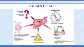 CAUSES OF ALF
 