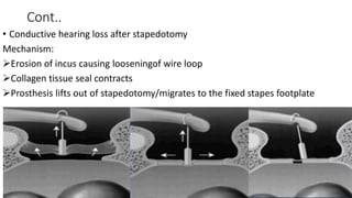 Cont..
• Conductive hearing loss after stapedotomy
Mechanism:
Erosion of incus causing looseningof wire loop
Collagen tissue seal contracts
Prosthesis lifts out of stapedotomy/migrates to the fixed stapes footplate
 