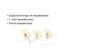• Surgical technique of stapedectomy
• 1. total stapedectomy
• Partial stapedectomy
 