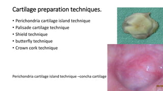 Cartilage preparation techniques.
• Perichondria cartilage island technique
• Palisade cartilage technique
• Shield technique
• butterfly technique
• Crown cork technique
Perichondria cartilage island technique –concha cartilage
 