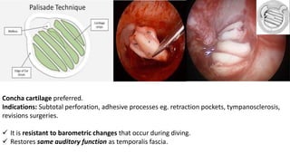 Concha cartilage preferred.
Indications: Subtotal perforation, adhesive processes eg. retraction pockets, tympanosclerosis,
revisions surgeries.
 It is resistant to barometric changes that occur during diving.
 Restores same auditory function as temporalis fascia.
 