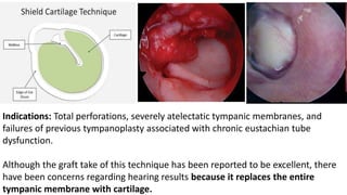 Indications: Total perforations, severely atelectatic tympanic membranes, and
failures of previous tympanoplasty associated with chronic eustachian tube
dysfunction.
Although the graft take of this technique has been reported to be excellent, there
have been concerns regarding hearing results because it replaces the entire
tympanic membrane with cartilage.
 