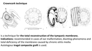 Is a technique for the total reconstruction of the tympanic membrane,
Indications: recommended in cases of ear malformation, blunting-phenomena and
total deficiency of the membrane caused by chronic otitis media.
Autologous tragal composite graft is used.
Crowncork technique
 